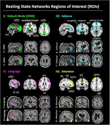 Neural Connectivity Changes Facilitated by Familiar Auditory Sensory Training in Disordered Consciousness: A TBI Pilot Study